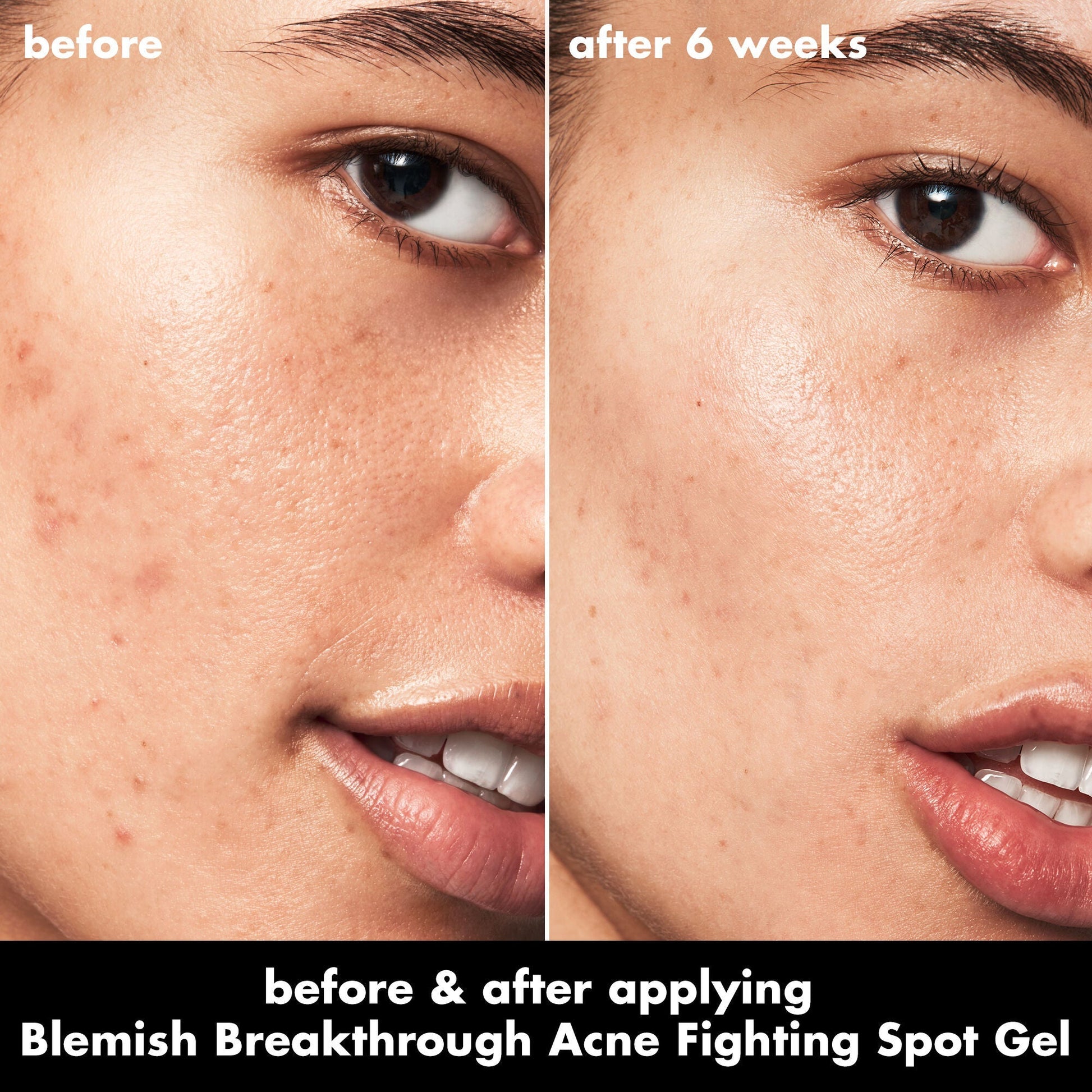 blemish-breakthrough-acne-fighting-spot-gel-v7 0326_EDU_BB_SpotGel_BA_ISABELLA.jpg
