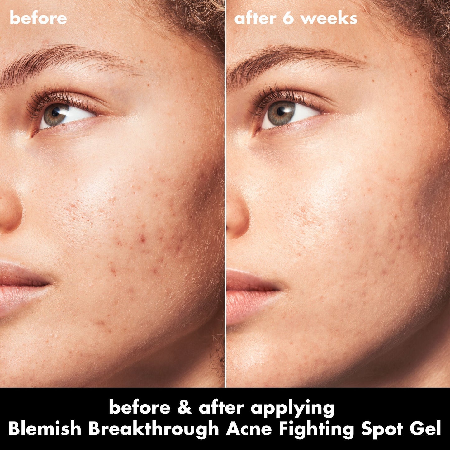 blemish-breakthrough-acne-fighting-spot-gel-v7 0326_EDU_BB_SpotGel_BA_MARLEY.jpg