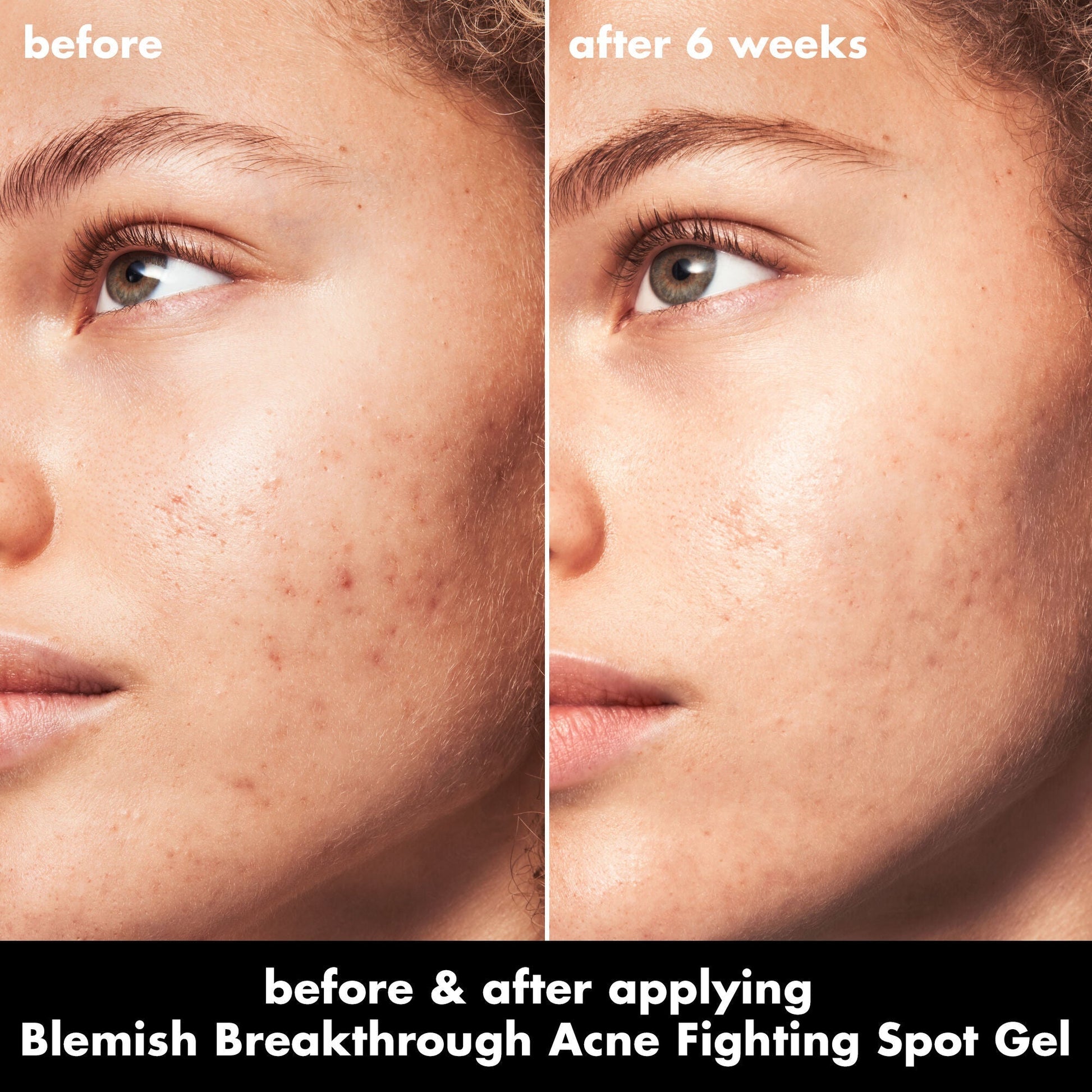 blemish-breakthrough-acne-fighting-spot-gel-v7 0326_EDU_BB_SpotGel_BA_MARLEY.jpg