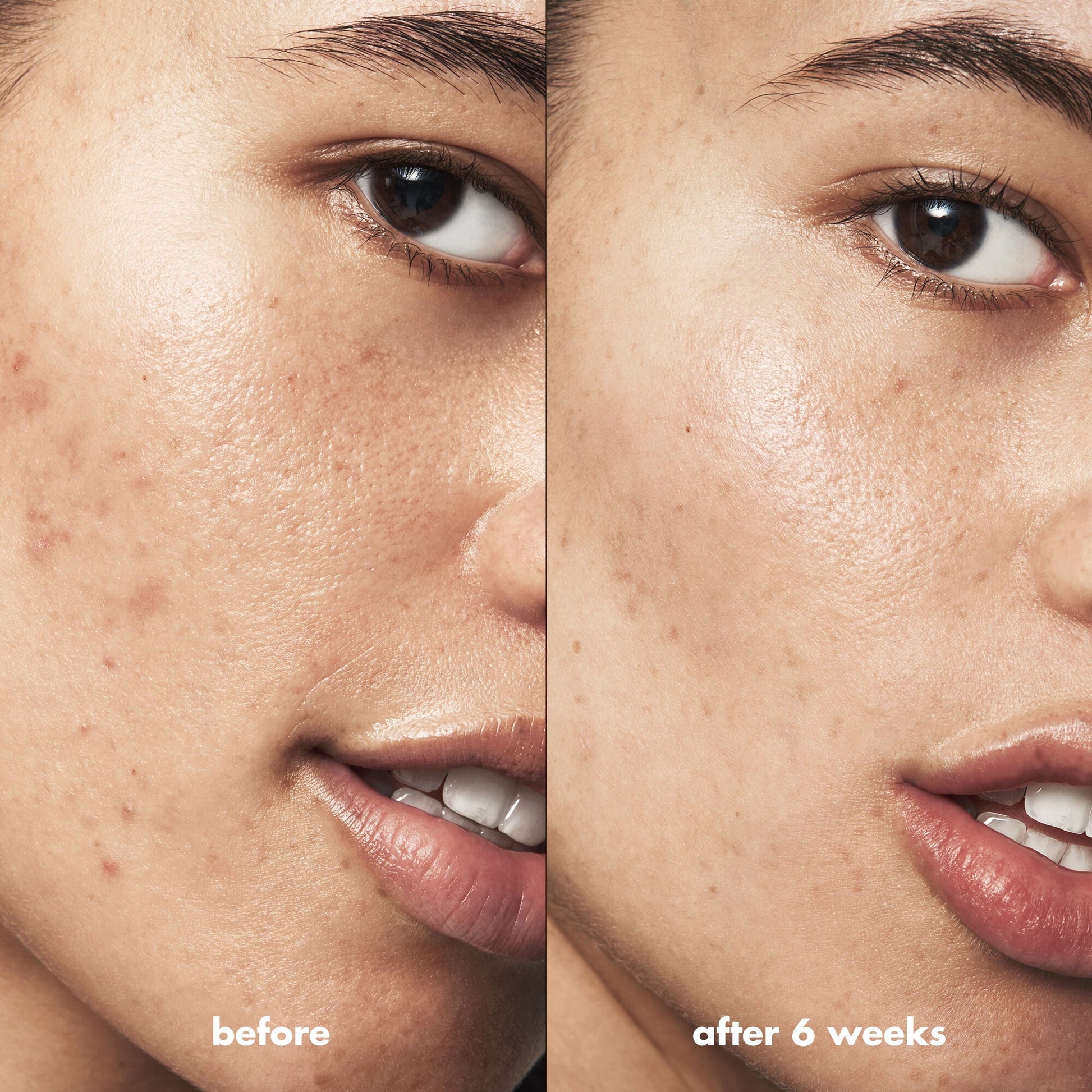 blemish-breakthrough-acne-clarifying-cleanser-p8 Acne_PDP_Isabella_Before_After_a3ff322b-cc6f-4b1a-9db3-bfb66c15d034.jpg