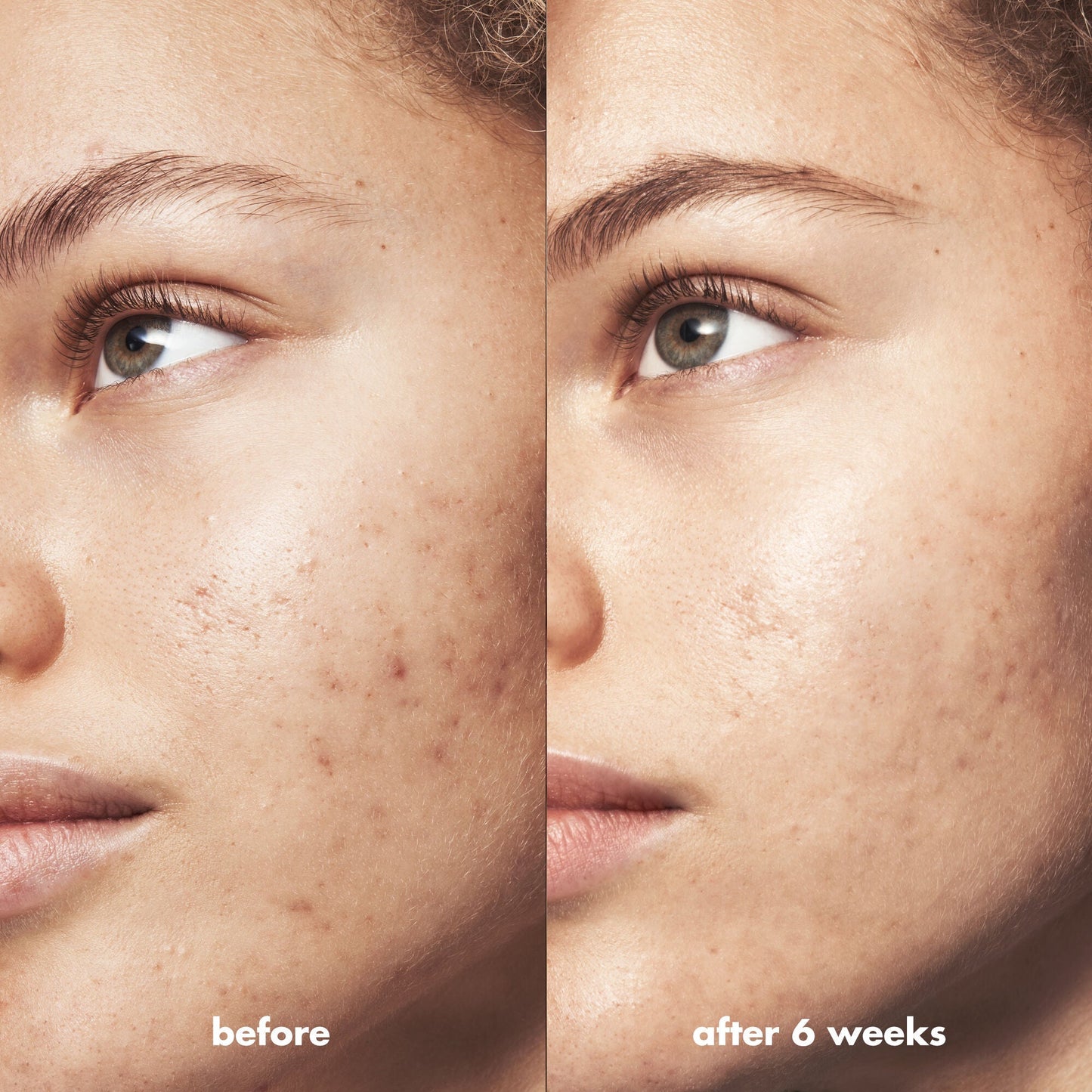blemish-breakthrough-triple-acid-resurfacing-serum-u2 Acne_PDP_Marley_Before_After_1a95cac5-0af6-43b6-a936-d0bacbdec0bf.jpg